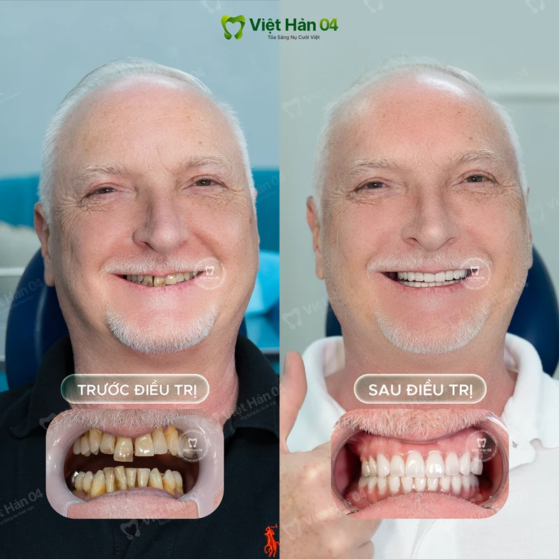 Từ Pháp đến Việt Hàn 04 - Chưa đến 10 ngày đã có lại cảm giác ăn nhai tự nhiên