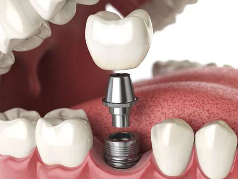 Cấu tạo của răng Implant nha khoa: Mão sứ, Abutment và Trụ Implant