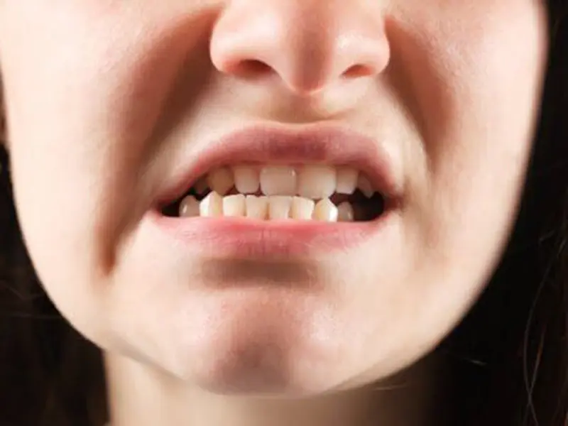 Biến dạng khuôn mặt, sai lệch khớp cắn nặng hơn