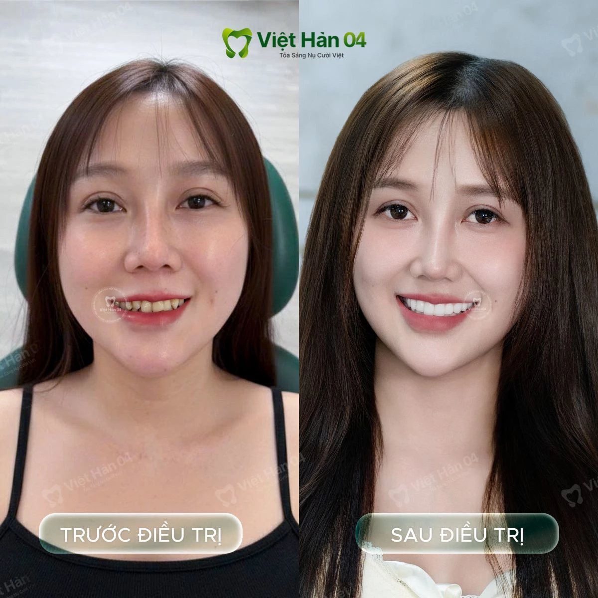 Khách hàng Minh Châu: Bọc 17 răng sứ Lava Plus