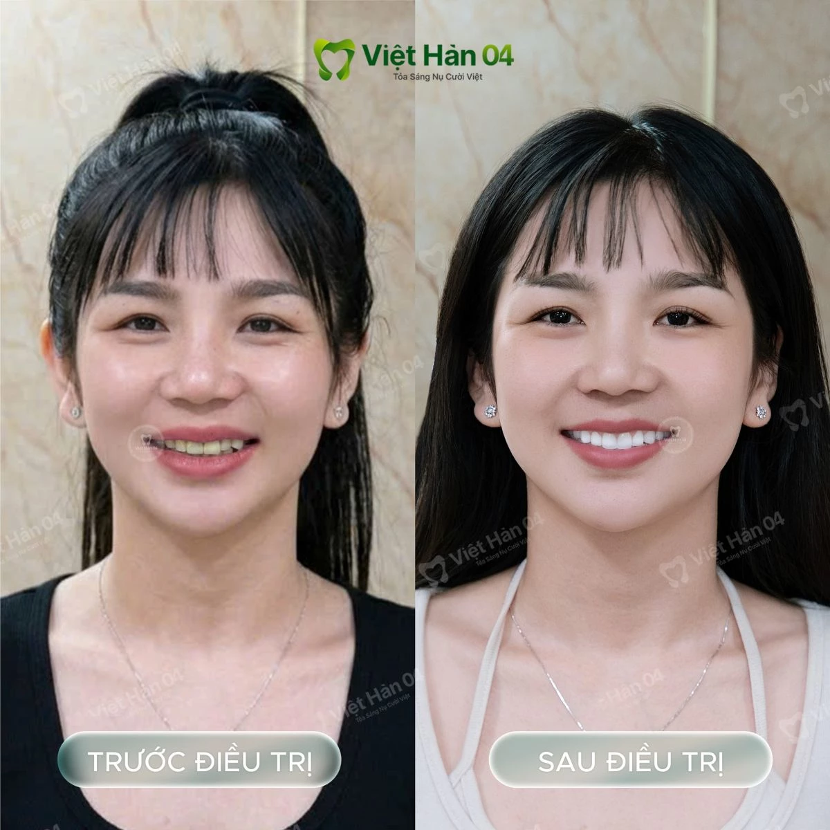 Khách hàng Quyền Trân: Bọc 20 răng sứ Lava Plus
