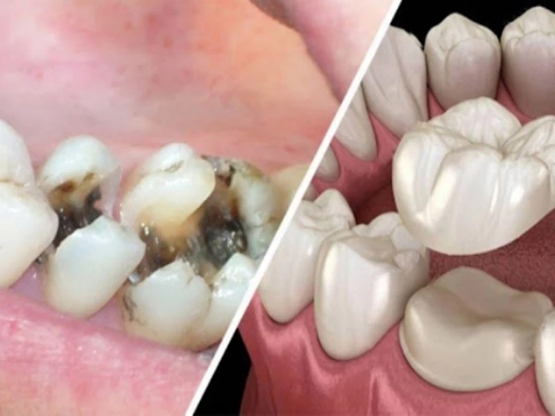 Hình ảnh bọc răng sứ bị tụt lợi