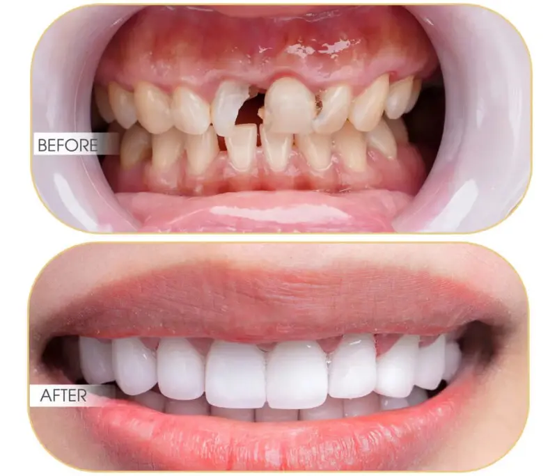Bọc răng sứ thẩm mỹ khôi phục hình dáng và chức năng cho răng cửa bị gãy
