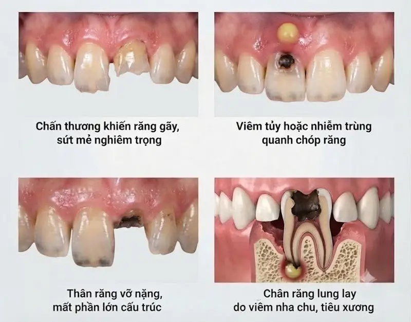 Các dấu hiệu cho thấy bạn nên cân nhắc trồng răng cửa hàm trên