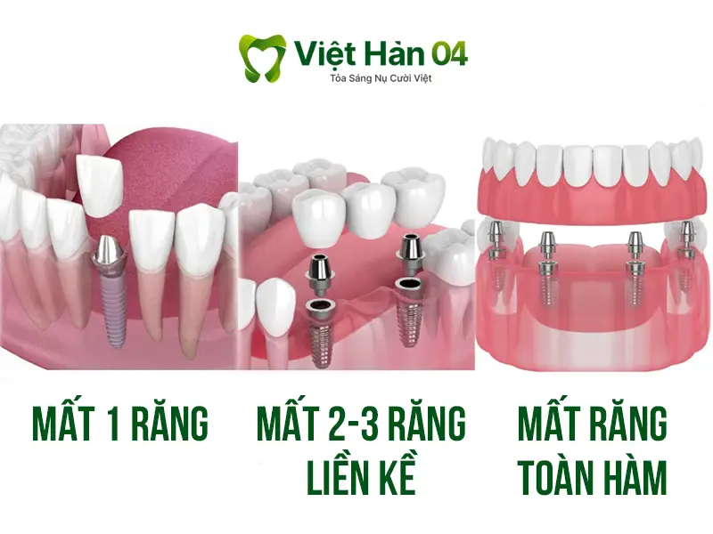 Các trường hợp mất răng