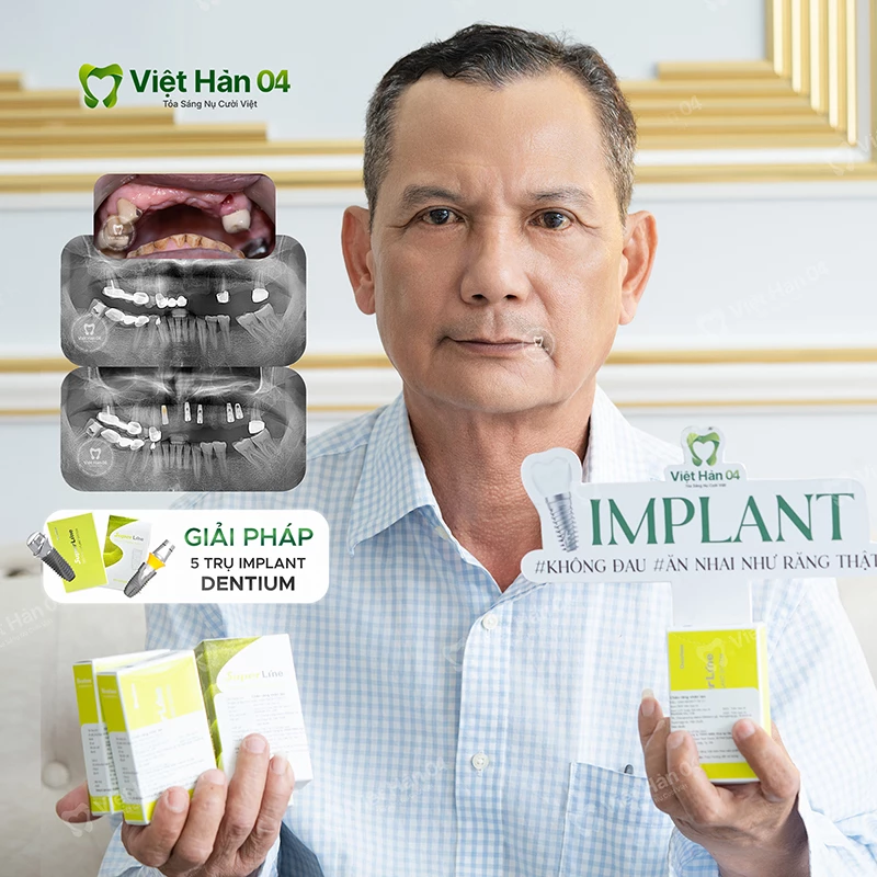 Cắm Implant 5 trụ Dentium