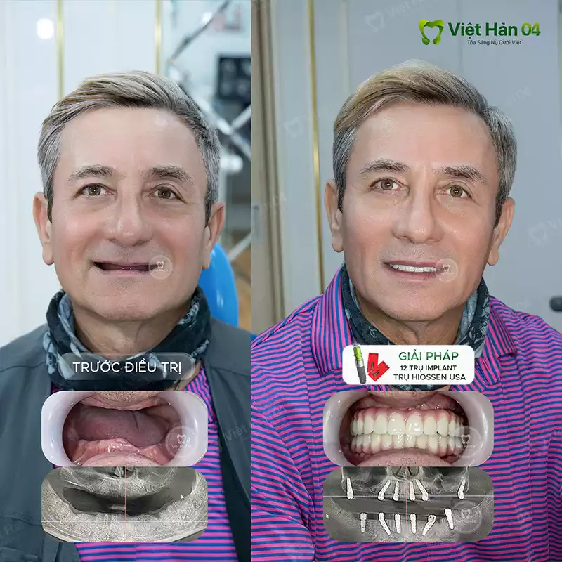Cấy ghép 12 trụ Implant Hiossen USA