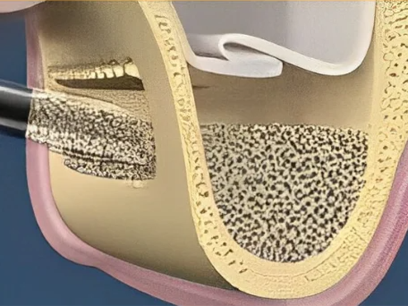 Kỹ thuật nâng xoang hàm bằng cách ghép xương
