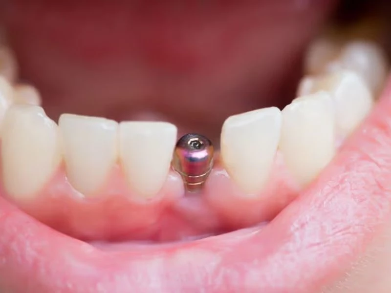 Cấy ghép implant không làm ảnh hưởng đến răng kế cạnh