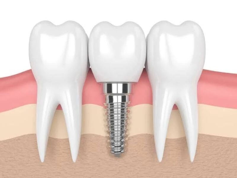 Cấy ghép Implant là một giải pháp phục hình răng đã mất tối ưu nhất 
