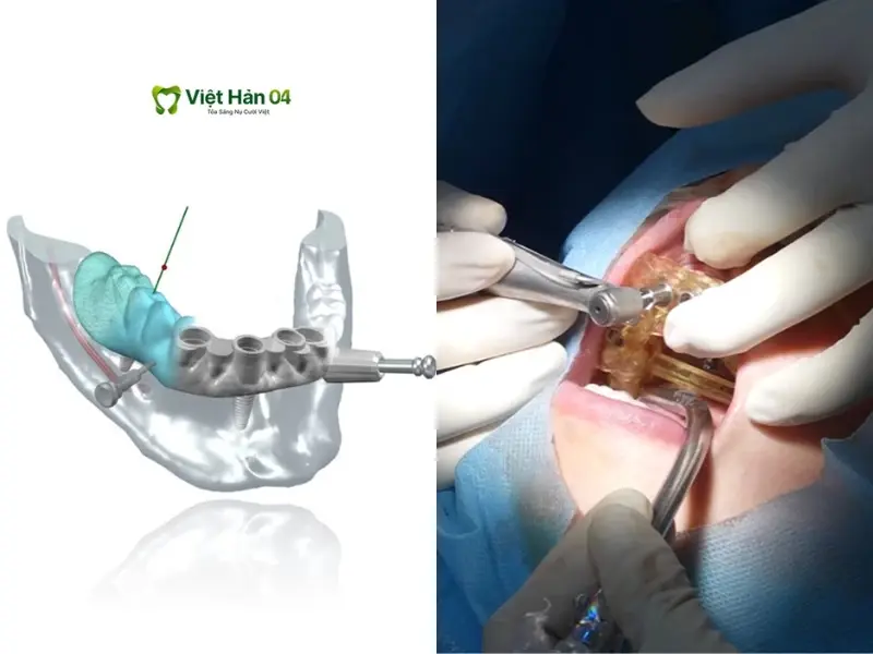  Đặt máng định vị lên răng khách và đưa trụ Implant vào vị trí qua lỗ định vị trên máng