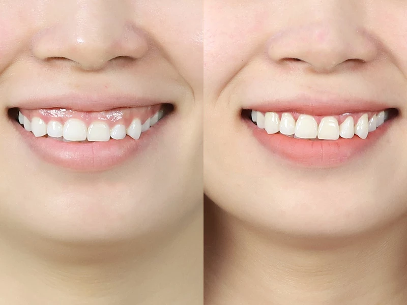 Cười hở lợi là gì