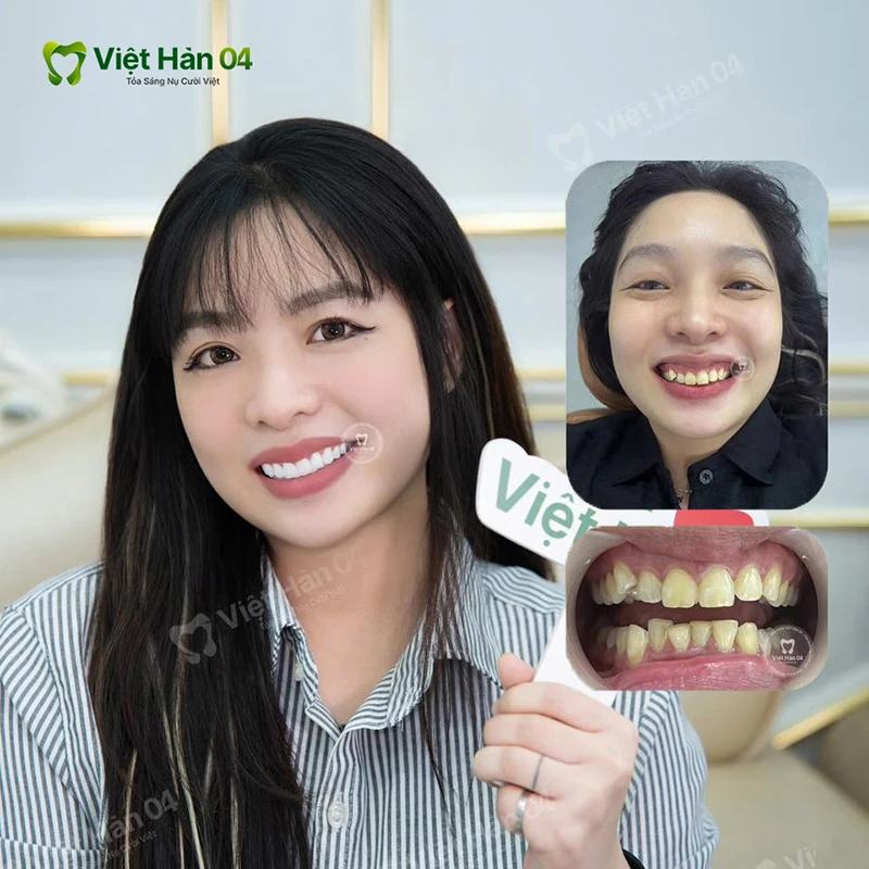 Khách hàng điều trợ cười hở lợi tại Việt Hàn 04
