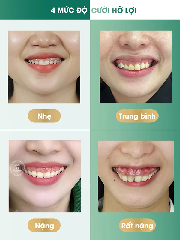 4 mức độ cười hở lợi