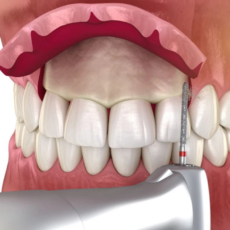 Phẫu thuật mài xương ổ