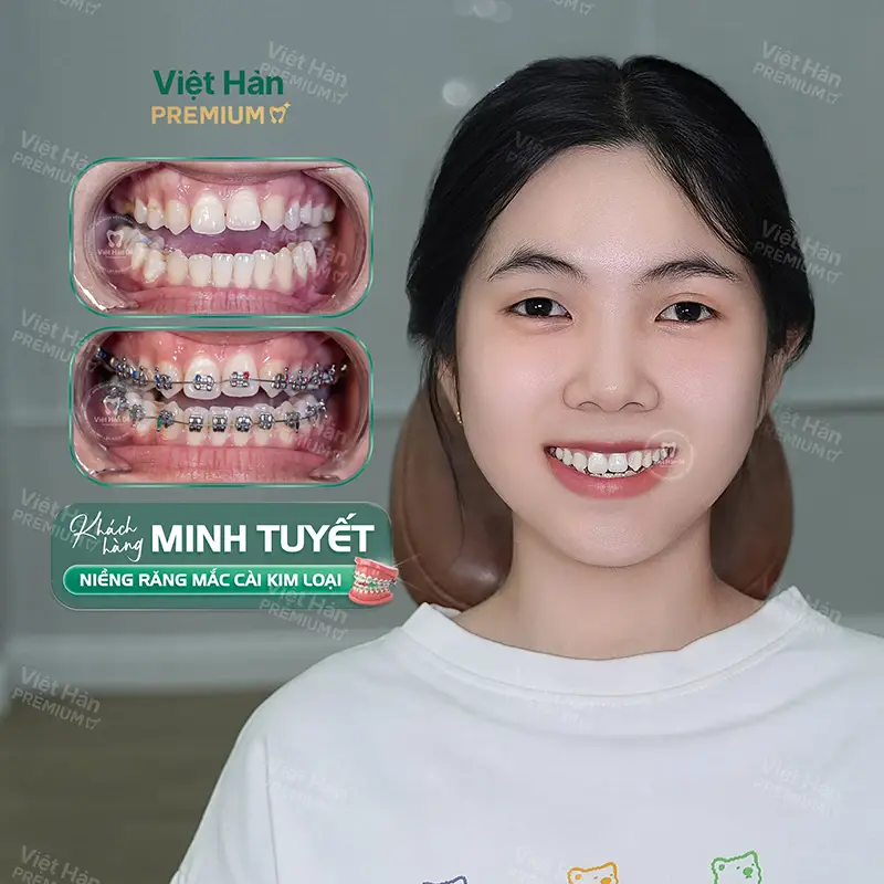 Độ tuổi thích hợp để niềng răng thẩm mỹ