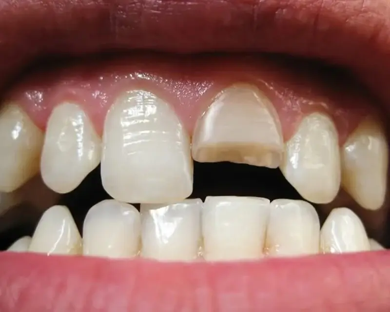 Gãy răng cửa mức độ trung bình