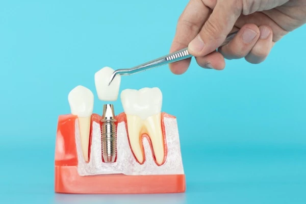 Đâu là cách trồng răng giúp tiết kiệm chi phí?