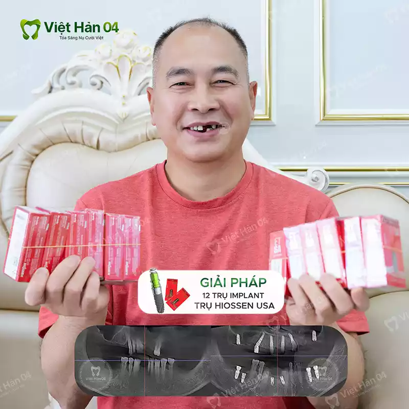 Giải pháp 12 trụ Implant Hiossen USA