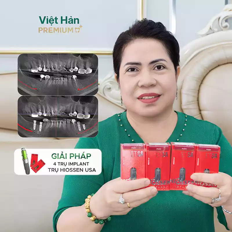 Giải pháp 4 trụ Implant Hiossen USA