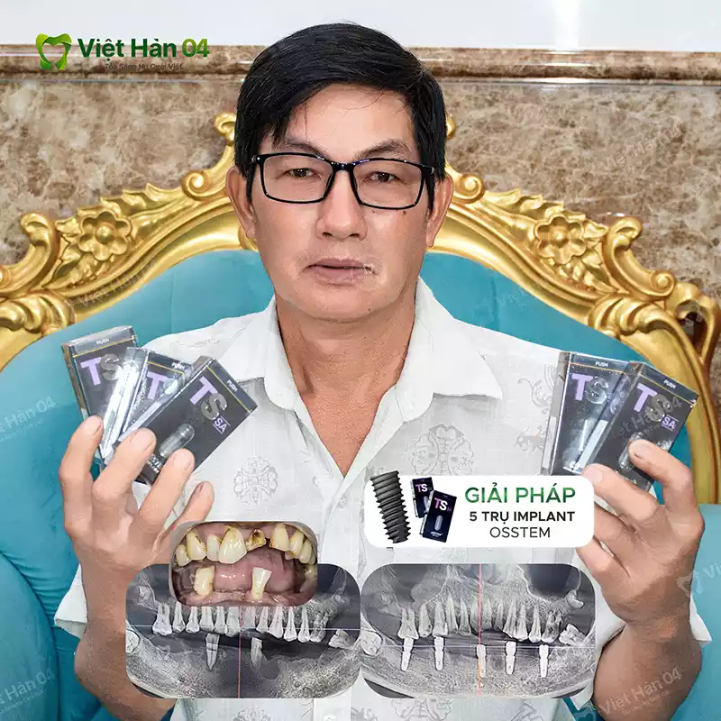 Giải pháp 5 trụ Implant Osstem 