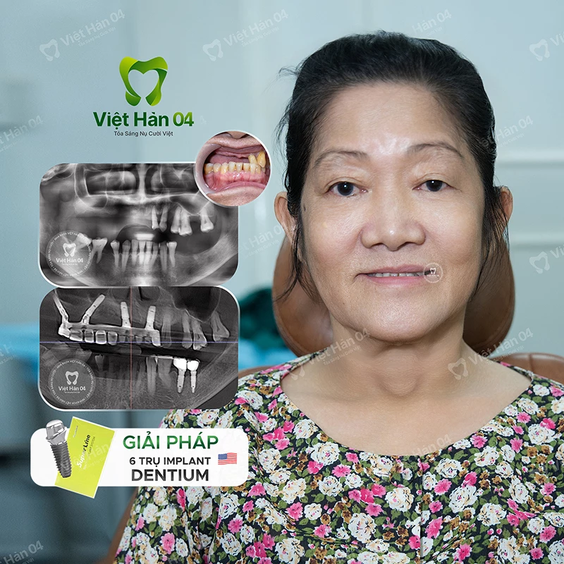 Giải pháp 6 trụ Implant Dentium