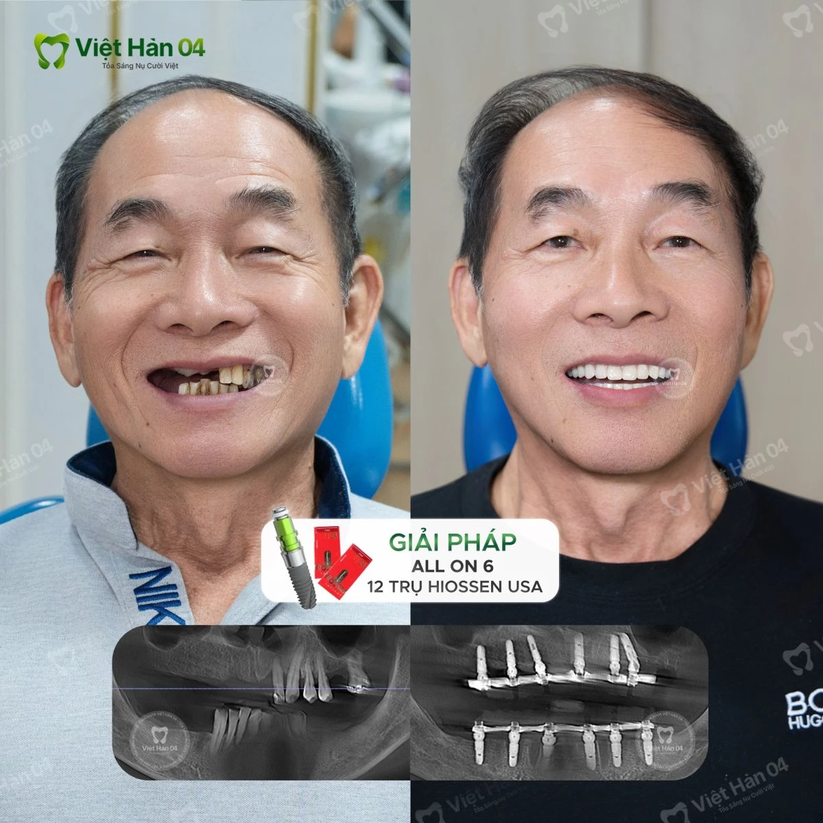 Giải pháp: Implant toàn hàm All On 6 với 12 trụ Hiossen