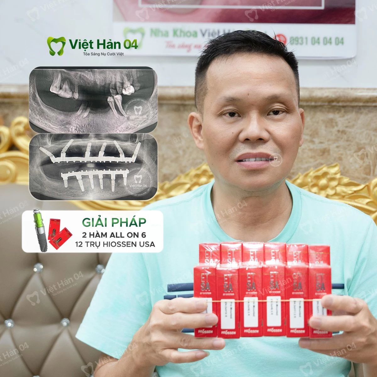 Giải pháp: Implant toàn hàm All On 6 với 12 trụ Implant Hiossen