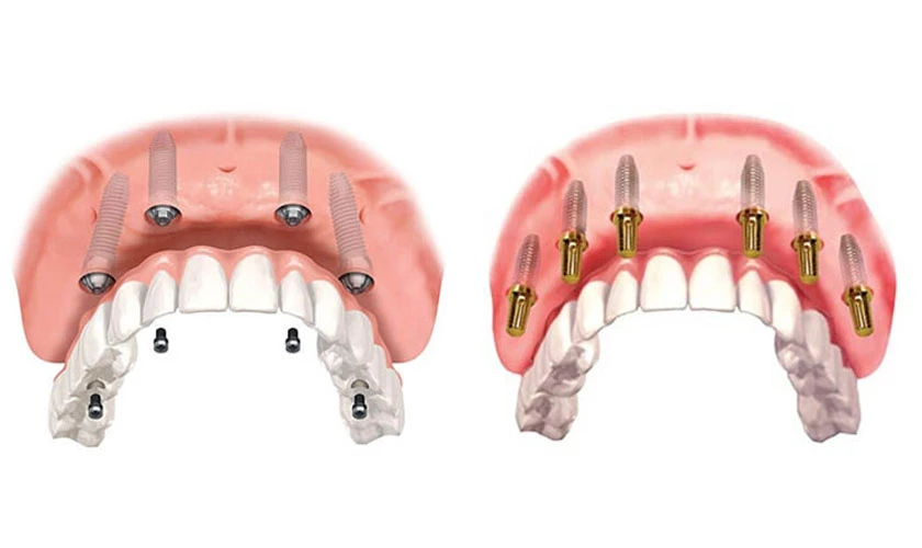 Hàm cố định trên implant