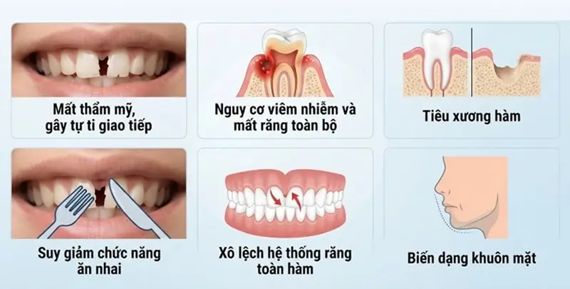 Hậu quả nghiêm trọng khi răng cửa bị gãy không khắc phục