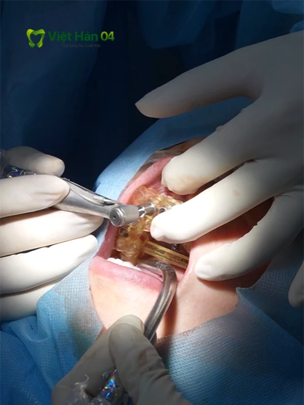 Hình ảnh cấy ghép Implant