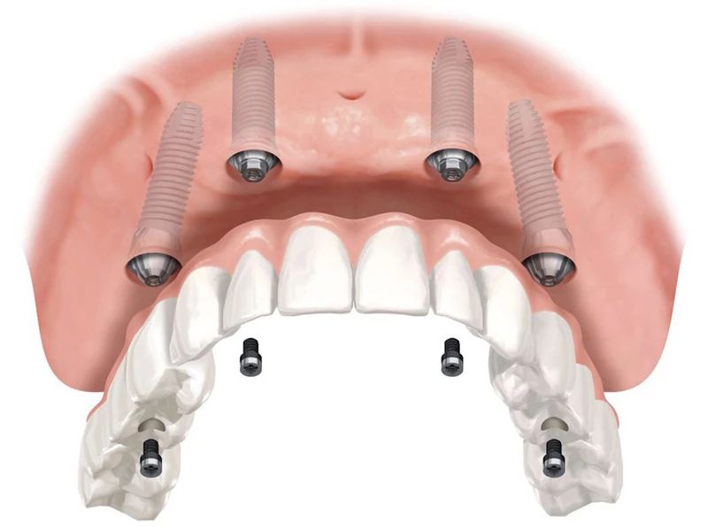 Hình ảnh Implant All On 4