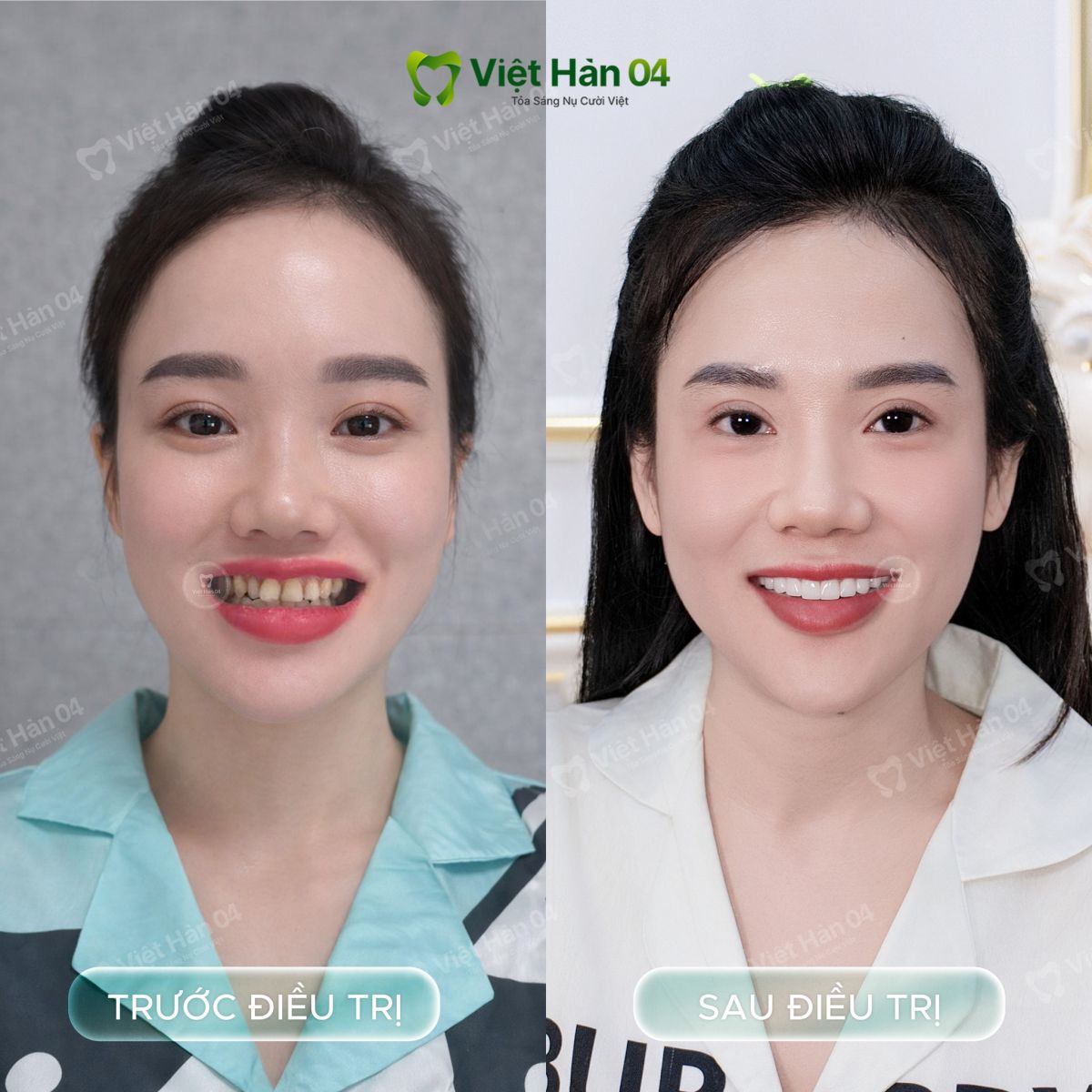Hình ảnh khách hàng Hoàng Nhi - Giải pháp bọc 22 răng sứ Lava 3M