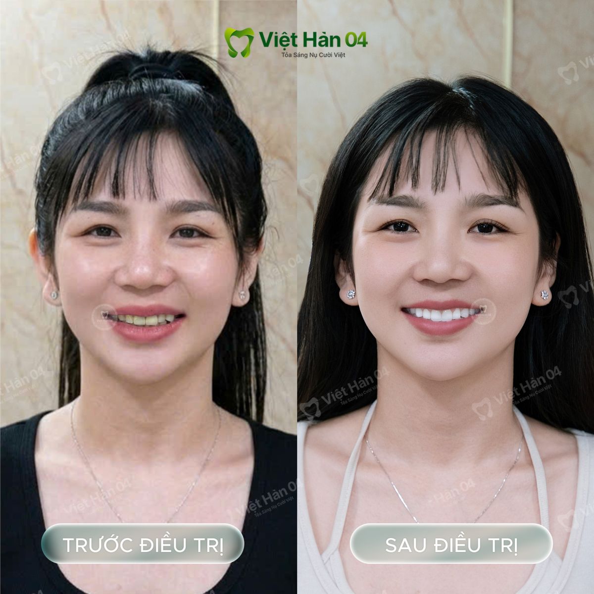 Hình ảnh khách hàng Quyền Trân - Giải pháp bọc 20 răng sứ Lava Plus