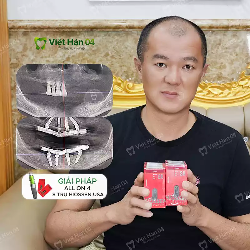 Implant All On 4 hàm trên hàm dưới - Implant Hiossen USA