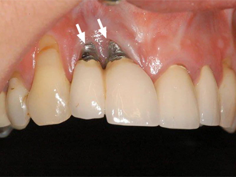 Hình ảnh đào thải trụ Implant