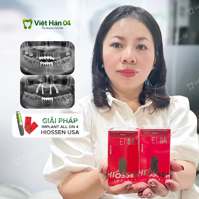 Implant nguyên hàm hàm trên All On 4 - Implant Hiossen USA