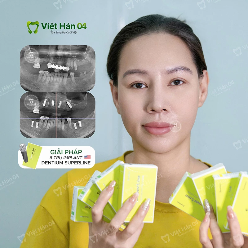 Implant toàn hàm All On 4 - Implant Dentium SuperLine