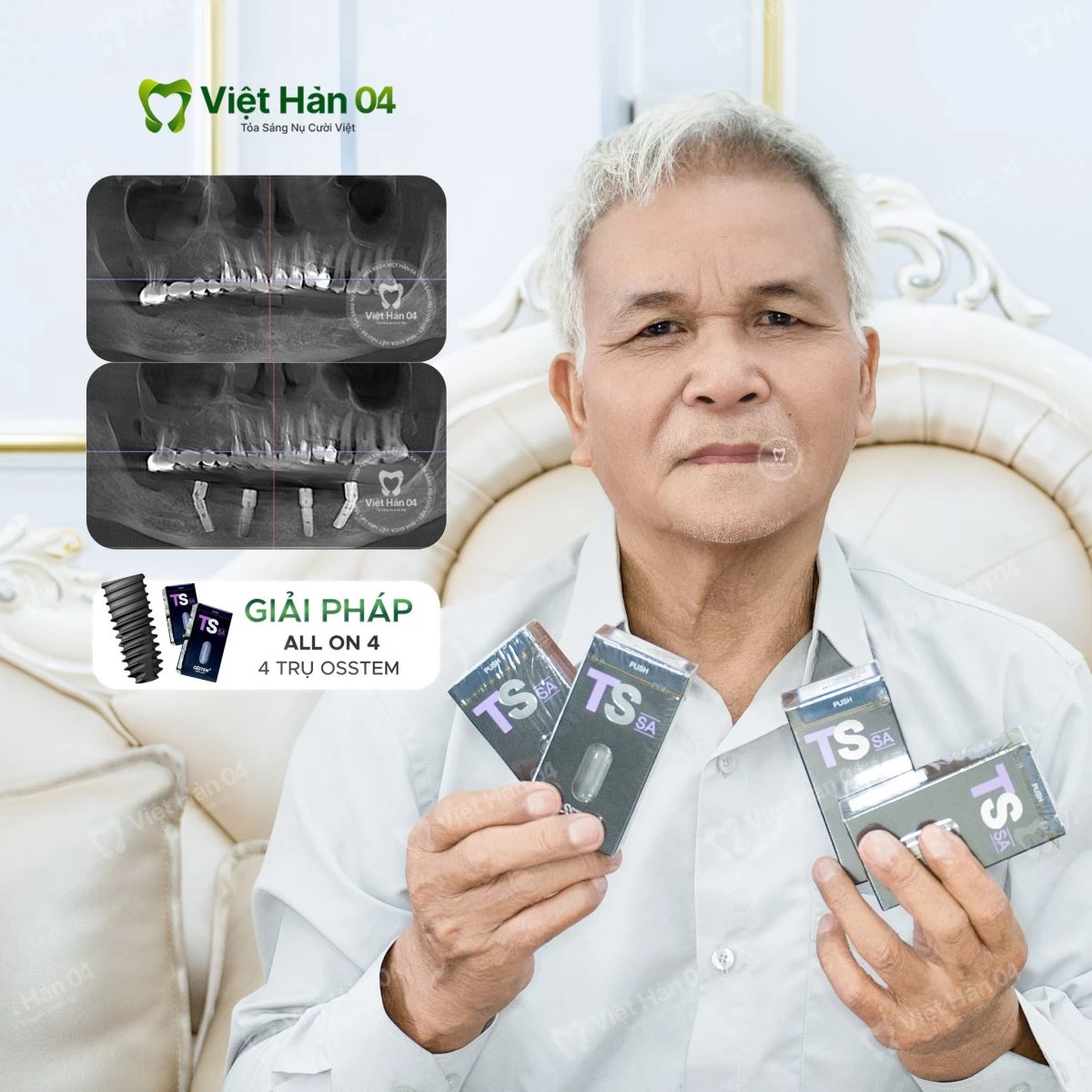 Giải pháp Implant toàn hàm All On 4 với 4 trụ Implant Osstem