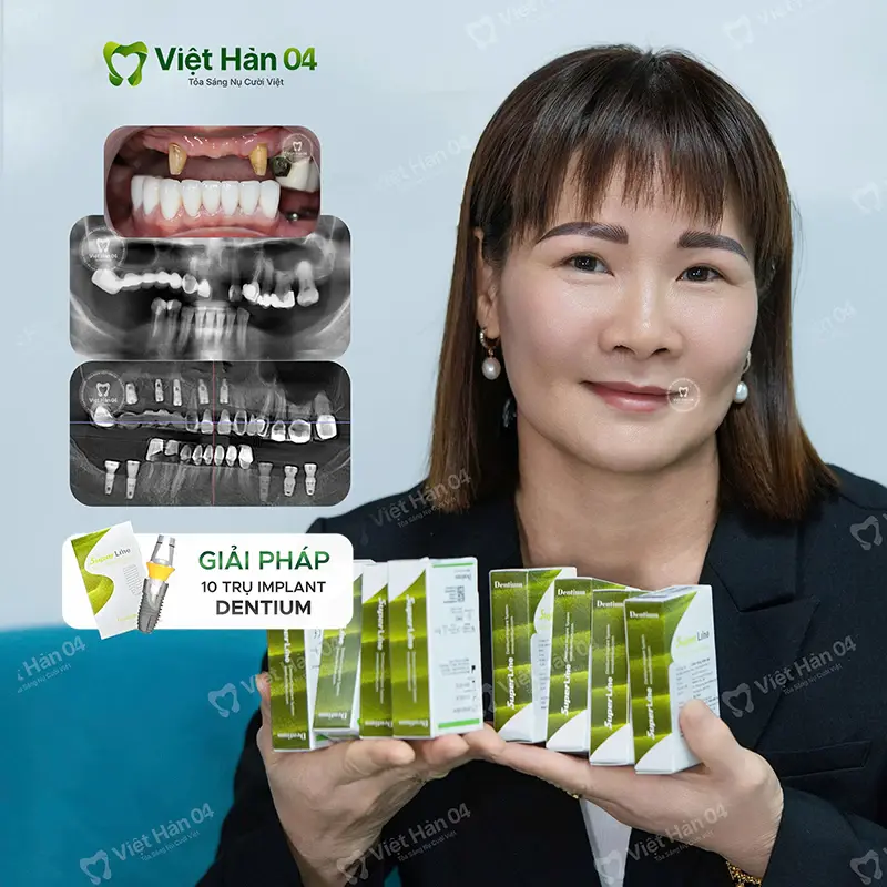 Khách hàng cắm 10 trụ Implant dentium Hàn Quốc