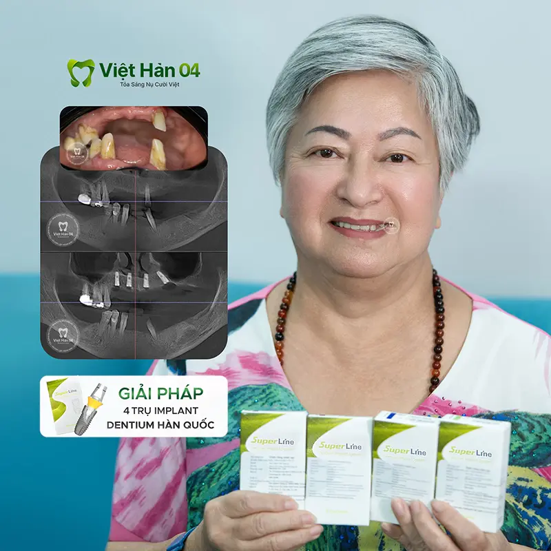 Khách hàng cắm 4 trụ Implant Dentium Hàn Quốc