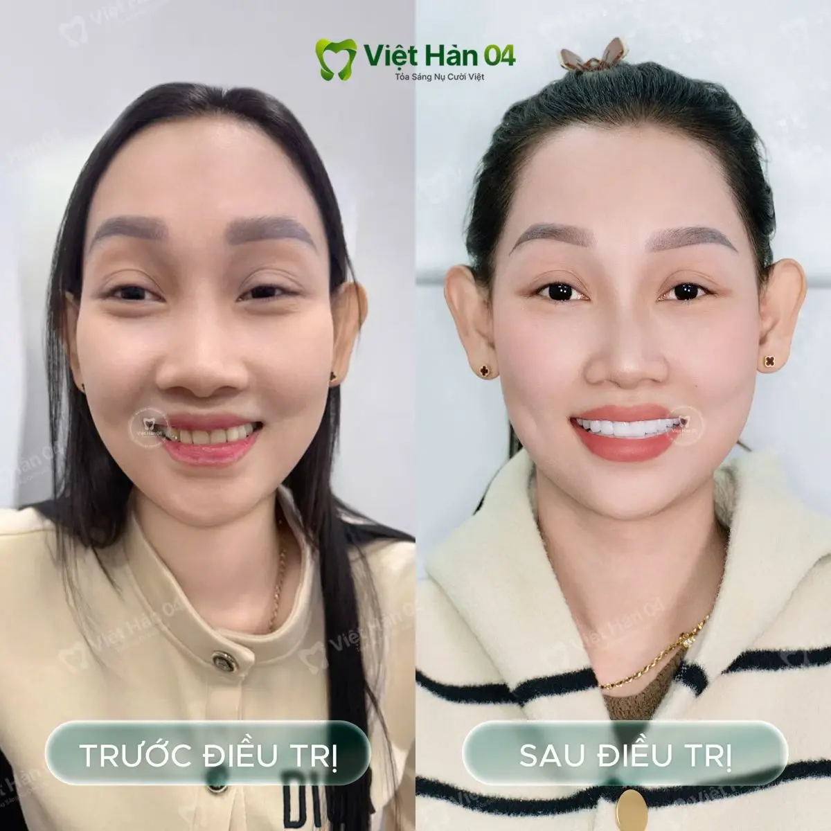 Khách hàng Cẩm Tú - Bọc 22 răng sứ Orodent White