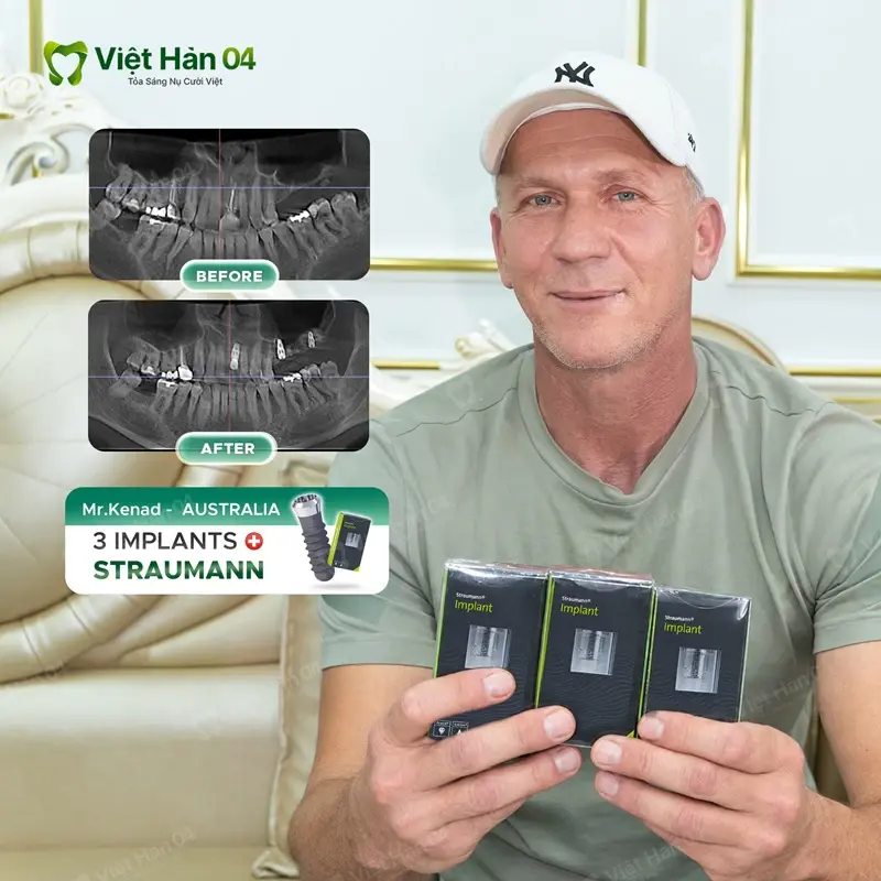 Khách hàng Ferizovic Kenad (Úc) - Trồng 3 trụ Implant Straumann Thụy Sỹ