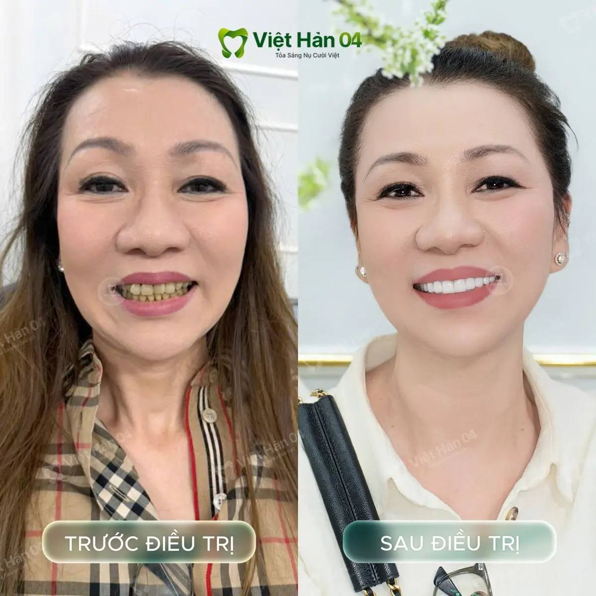 Khách hàng Hương Nguyễn - Bọc 20 răng sứ Lava Plus