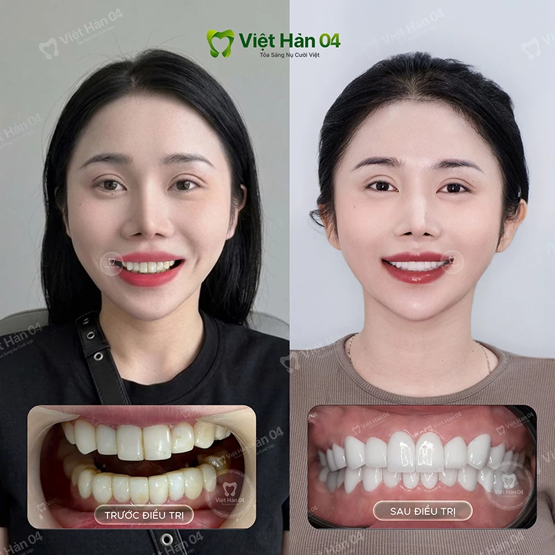 Khách hàng Khả Nhi bọc lại sứ 2 hàm trên dưới - Nha Khoa Việt Hàn 04