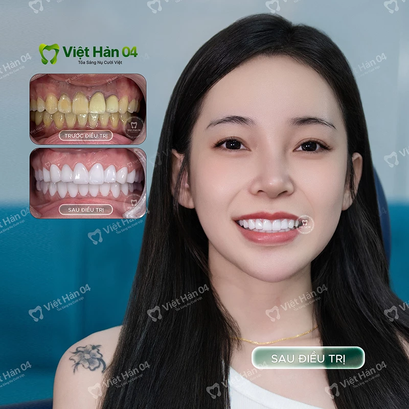 Khách hàng Kim Thơ bọc sứ 2 hàm - Nha Khoa Việt Hàn 04