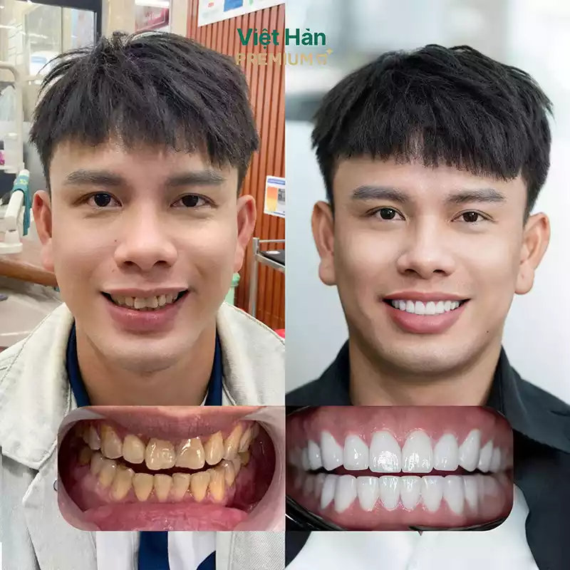 Hình ảnh khách hàng nam bọc răng sứ 2 hàm tại nha khoa Việt Hàn Premium