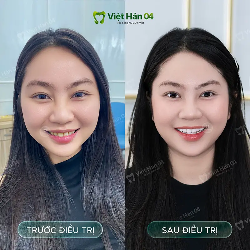 Khách hàng Ngân Giang - Bọc 16 răng sứ Lava Plus tại Nha Khoa Việt Hàn 04