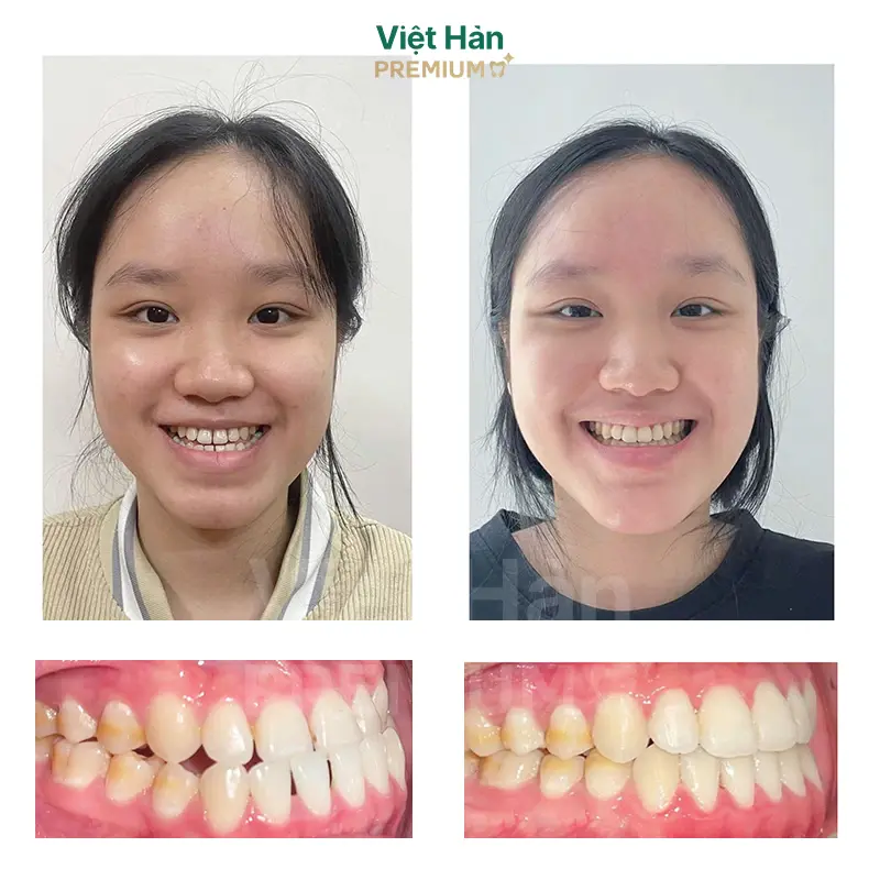 Khách hàng niềng răng thẩm mỹ tại nha khoa Việt Hàn Premium Thủ Dầu Một Bình Dương