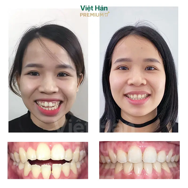 Khách hàng niềng răng thẩm mỹ tại nha khoa Việt Hàn Premium Thủ Dầu Một Bình Dương